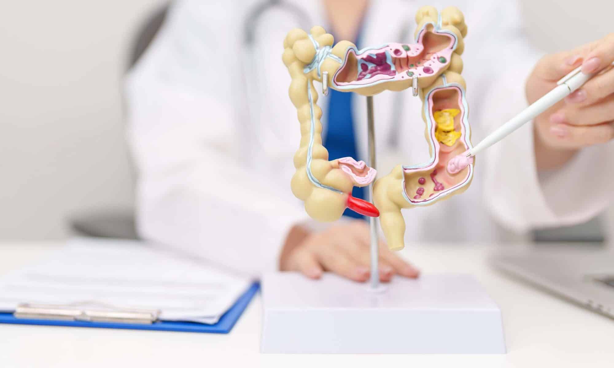 Diverticulitis Symptoms, Treatment, Diet & When to Go to the ER