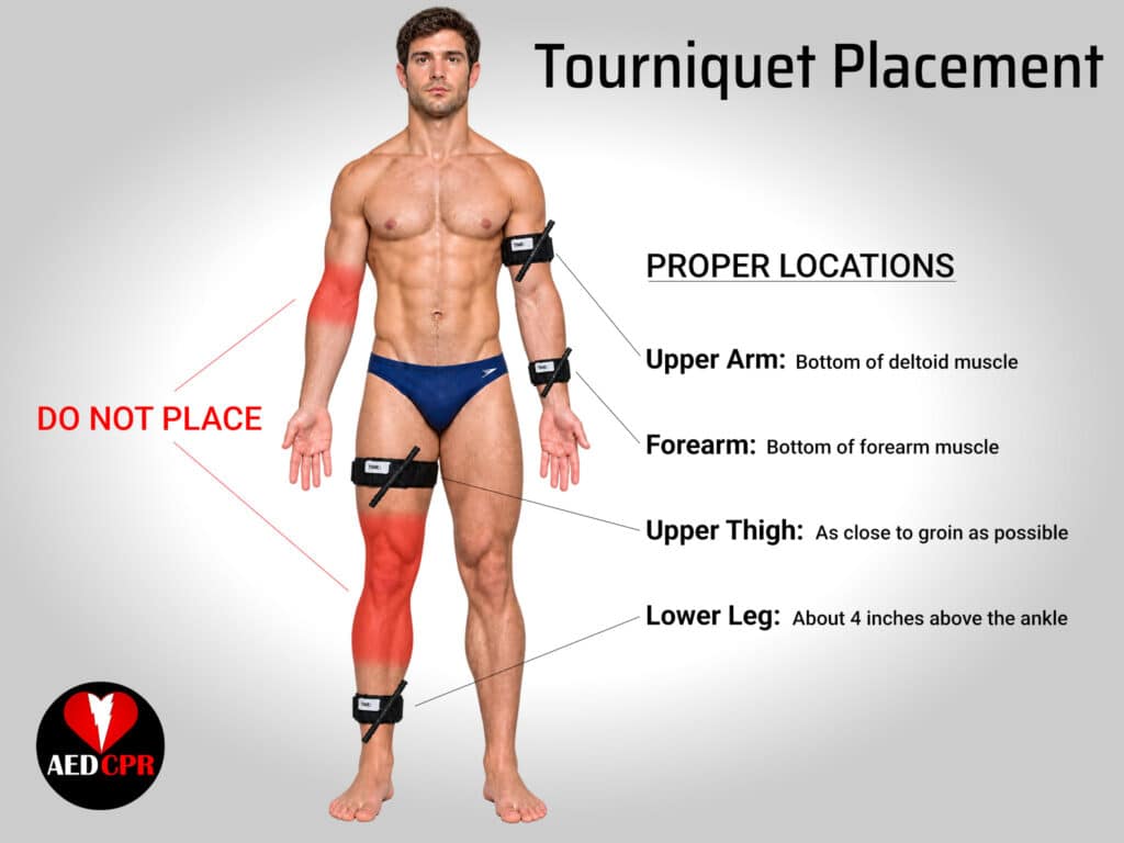 Proper tourniquet placement
