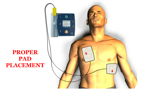 Place pads on victim's bare chest. Turn on the AED, let the AED analyze the victim's pulse. Perform CPR if necessary.